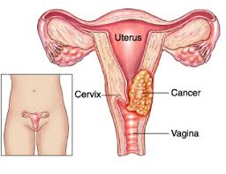 cervical cancer in Ngeria