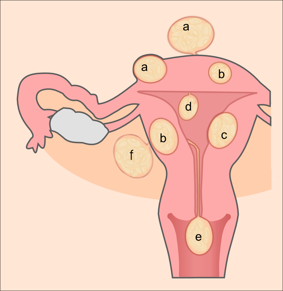 uterine fibroids