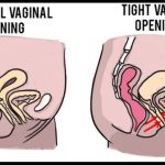 Vaginismus