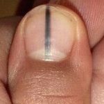 Nail Cancer (Subungual Melanoma)