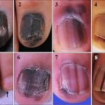 Subungual melanoma 