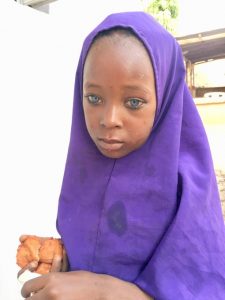 Blue sclera (Waardenburg Syndrome)