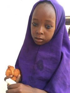 Waardenburg Syndrome