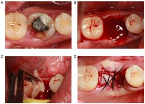 Tooth extraction