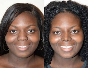 Non Surgical Nose Job 