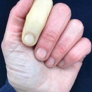 Reynaud Syndrome Pictures (Hand and Finger): Fingers turn white and ...