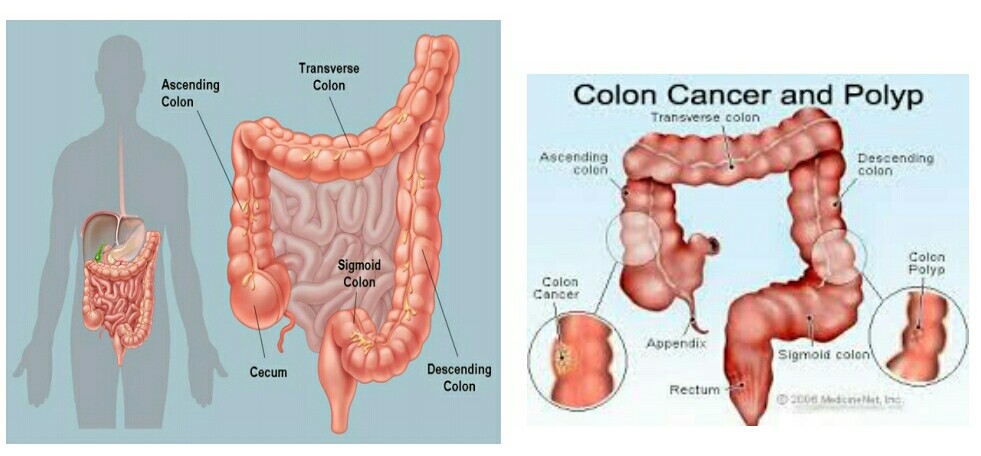 Early Symptoms And Signs Of Colon Cancer Large Intestine