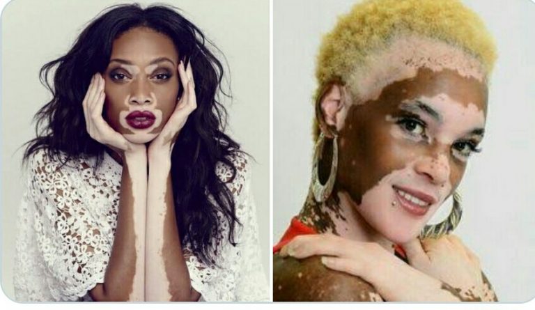 Vitiligo Facts Myths Causes Symptoms Pictures Treatment Nigerian Health Blog 5403