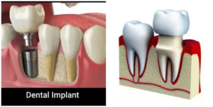 How much does it cost to replace a tooth in Nigeria? - Nigerian Health Blog