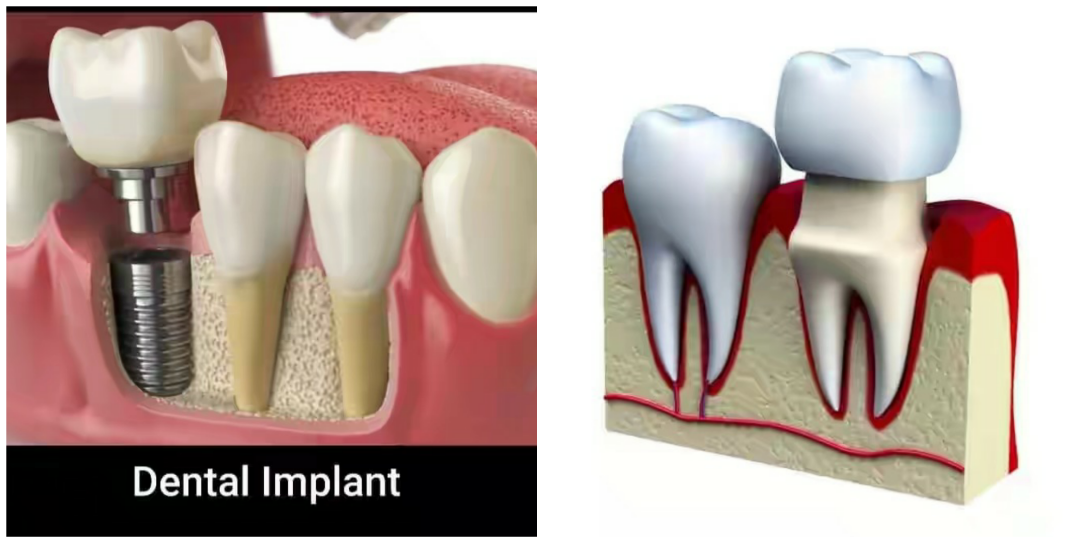 How Much Does It Cost To Replace A Tooth In Nigeria Nigerian Health Blog