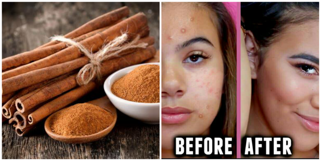 How to use apple cedar vinegar, tea tree oil, honey & cinnamon to cure