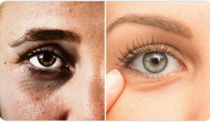 Dark circles removal cream in Nigeria