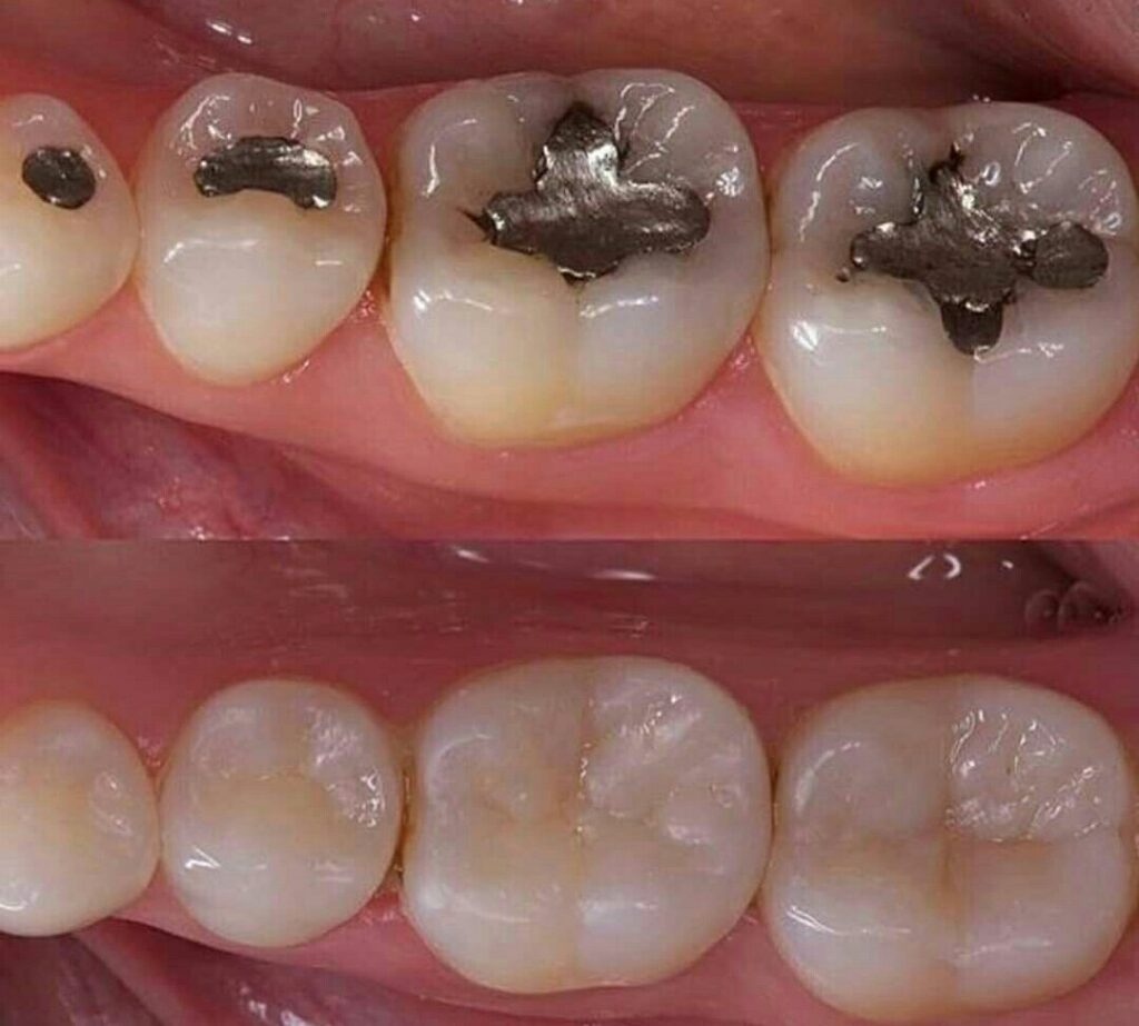 How much does tooth filling cost in Nigeria? (+ Procedures) Nigerian