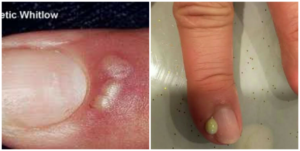 Whitlow Vs Paronychia: The difference between Whitlow and Paronychia
