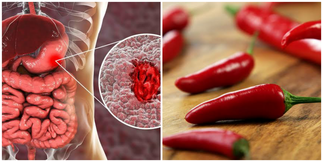 Does hunger or eating too much pepper cause stomach ulcer? Nigerian