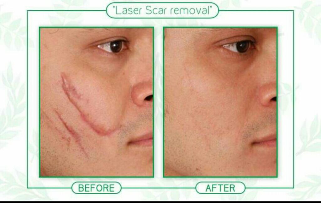 How much does laser Scar removal Cost in Nigeria? Nigerian Health Blog