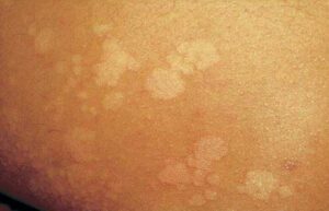 Top Eczema Treatment Creams in Nigeria