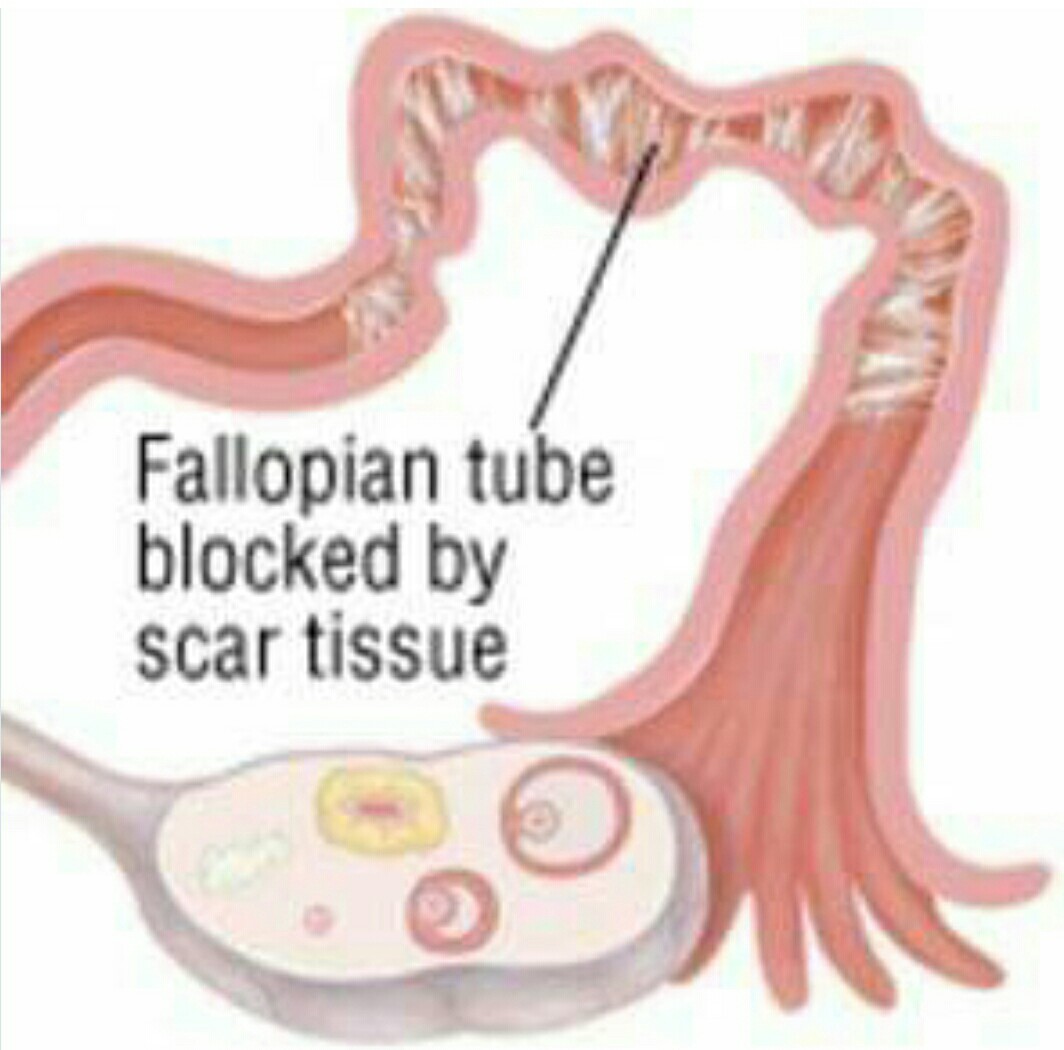 herbal-treatment-for-blocked-fallopian-tubes-in-nigeria-nigerian