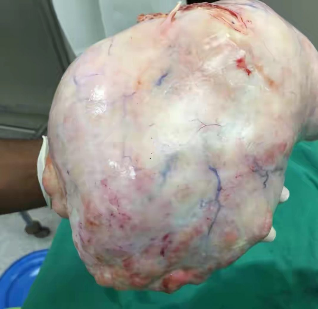 arian Cyst Removal: Cost of ovarian cyst surgery in Nigeria