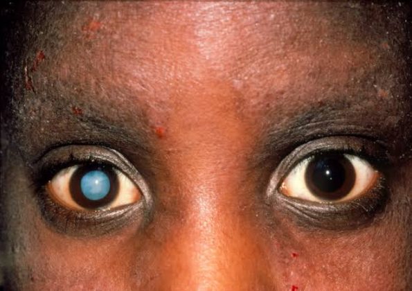 how-much-does-cataract-surgery-cost-in-nigeria-nigerian-health-blog