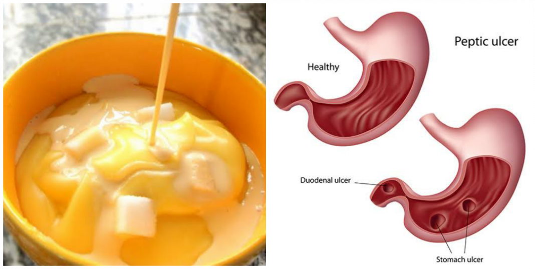 Can Akamu heal ulcer? Can Akamu Cure Ulcer? Is (raw) Akamu good for ulcer patient?