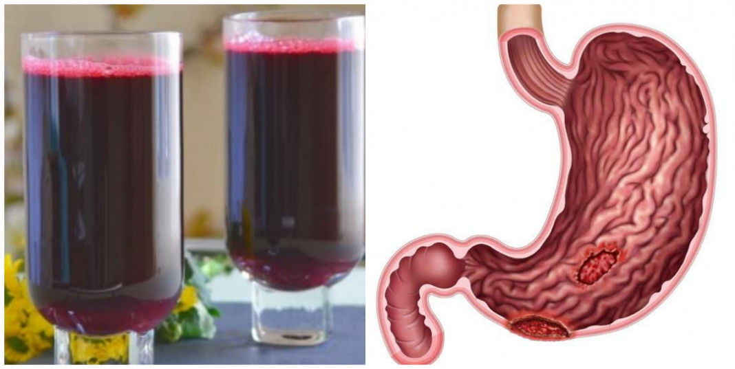 Is Zobo drink good for ulcer patient? Is Zobo drink good for ulcer patient?