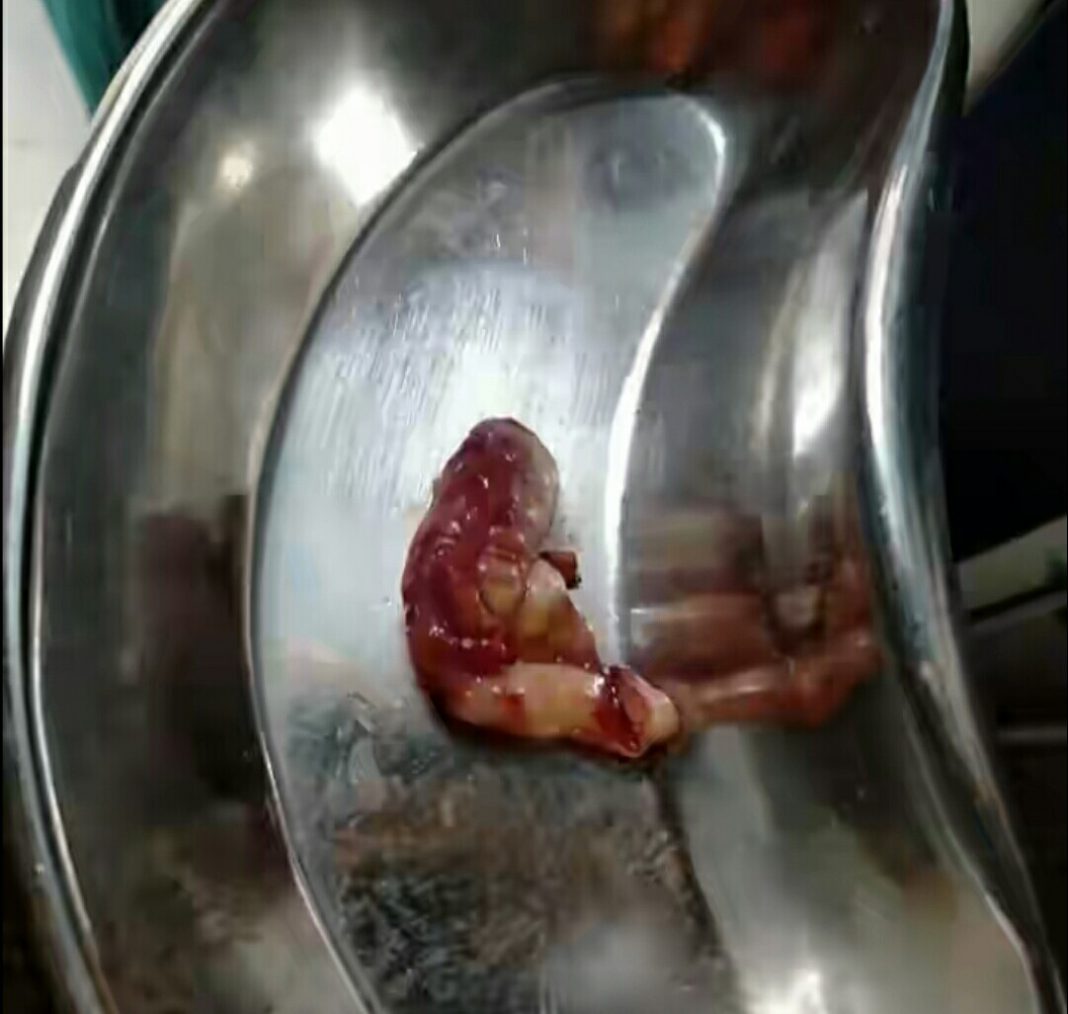 Cost of appendix surgery in Kenya (Appendectomy) Cost of appendix surgery in Kenya (Appendectomy)