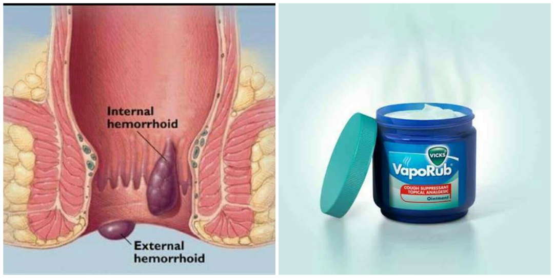 How to use Vicks VapoRub for hemorrhoids Pain Relief