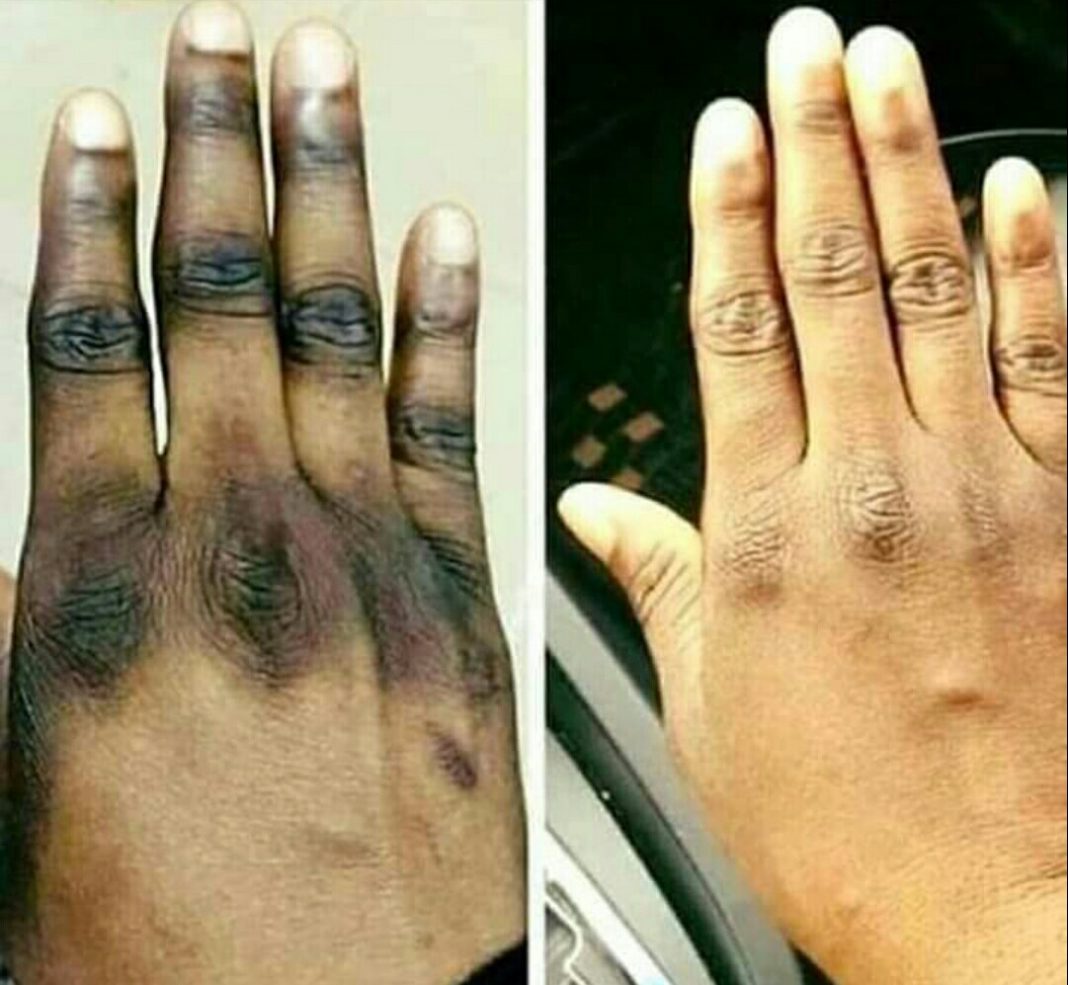 Best cream for dark knuckles in Ghana Best cream for dark knuckles in Ghana