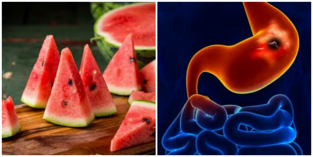 Is watermelon OK for ulcer patient? Is watermelon good for ulcer patient?