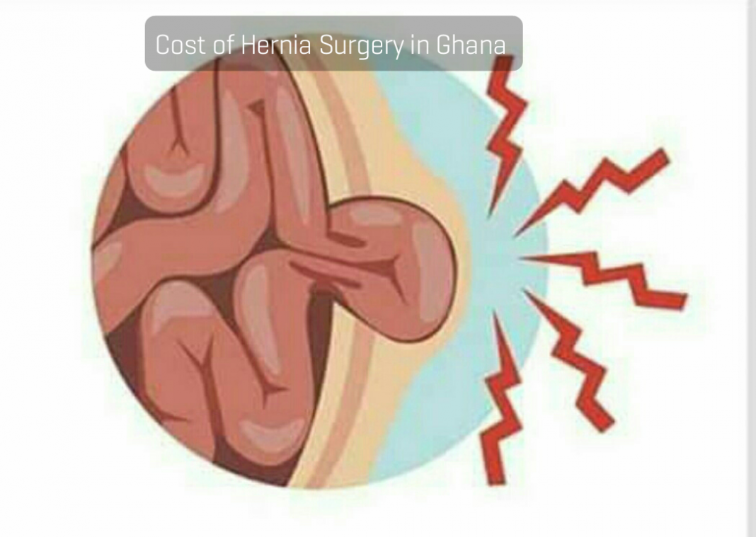 Price of hernia surgery in Ghana Cost of hernia surgery in Ghana - Hernias and Hernia Operation