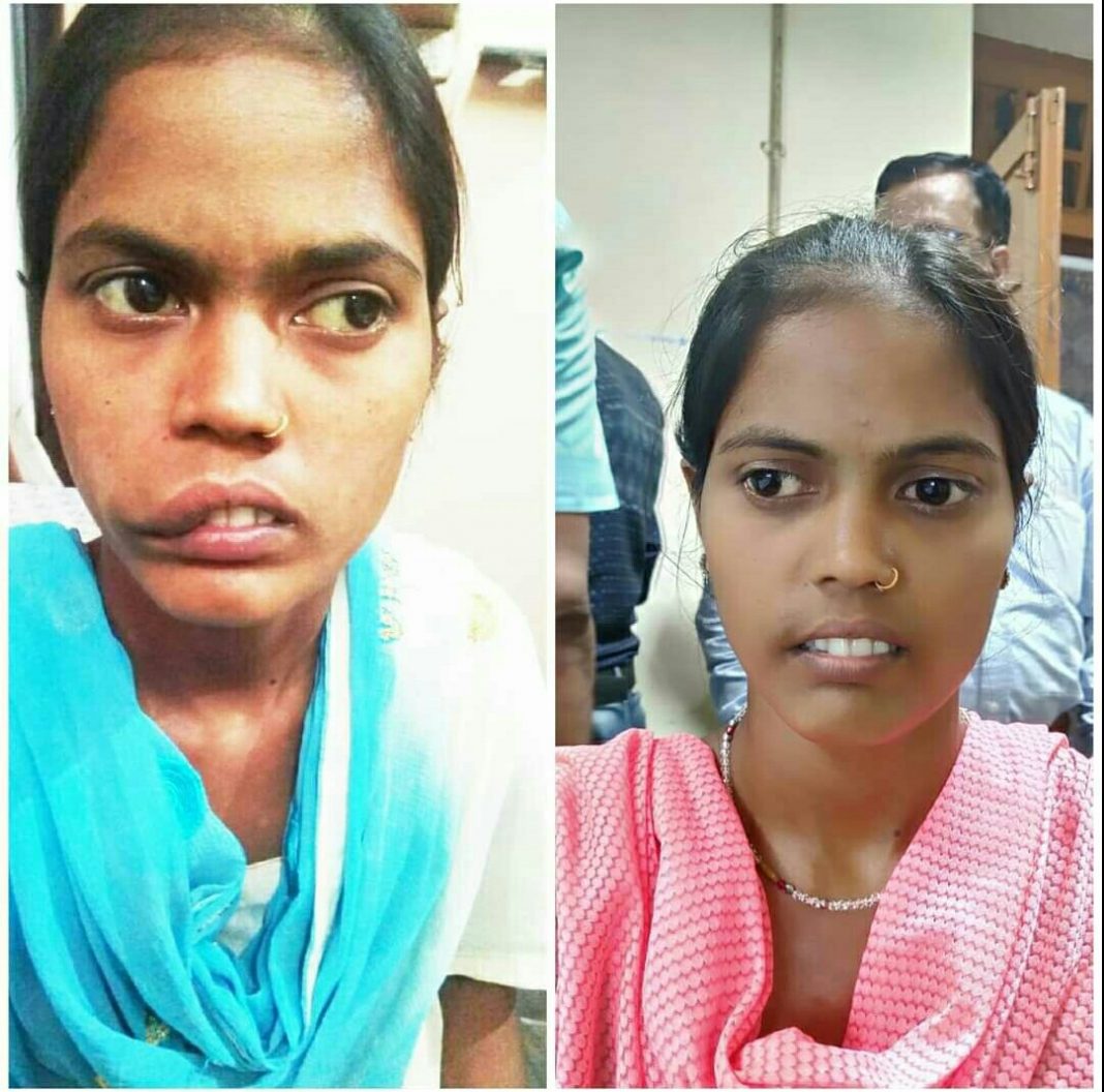 Screenshot_20210506-105842-1 Lip Reduction Surgery in Ghana and Nigeria including Cost