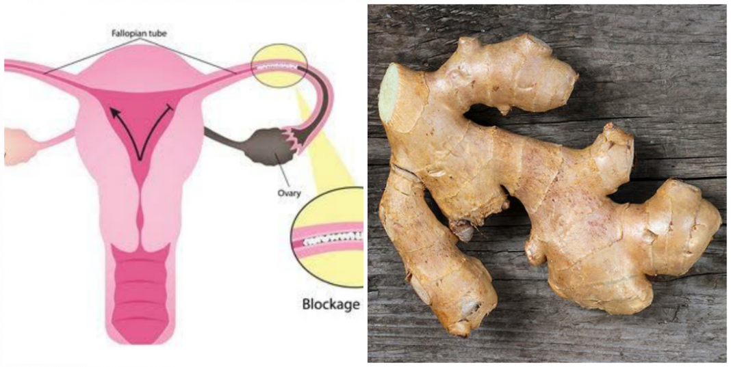How to use ginger to unblock fallopian tube