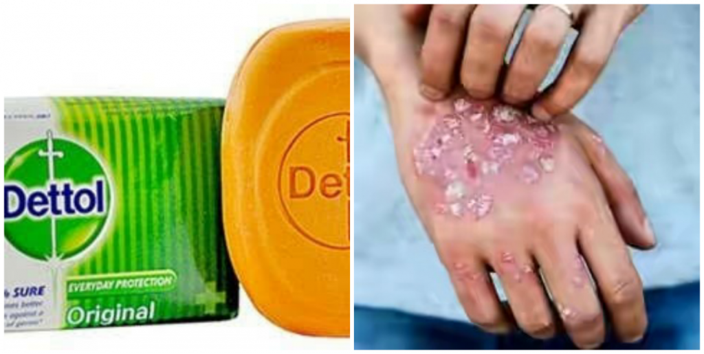 Can dettol kill scabies? Can dettol get rid of scabies? Nigerian