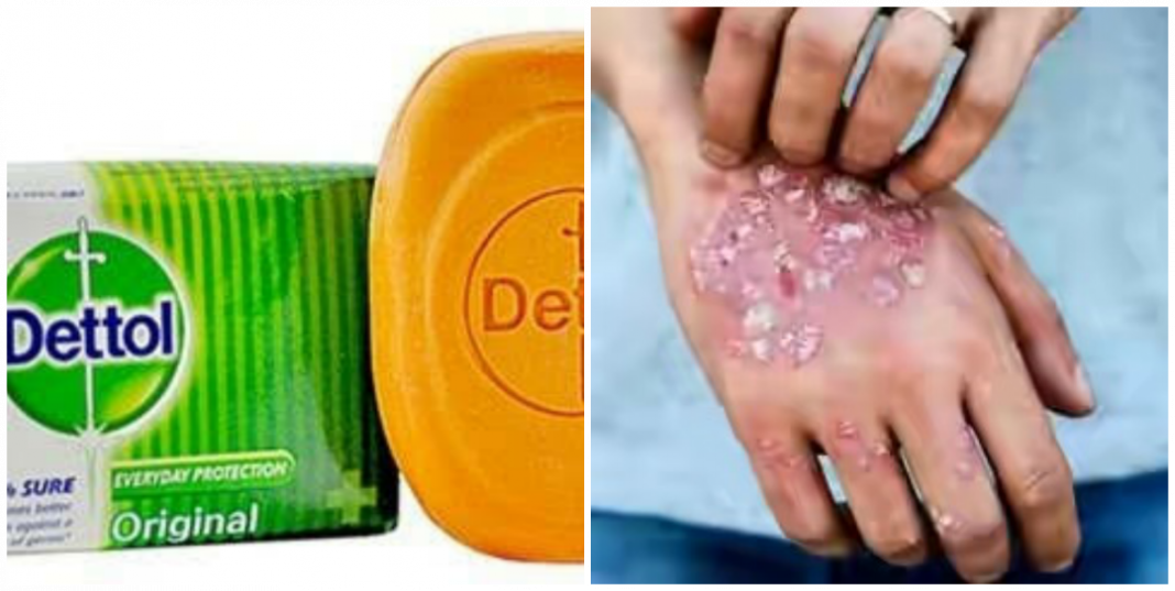 How to use dettol to get rid of scabies Can dettol kill scabies?