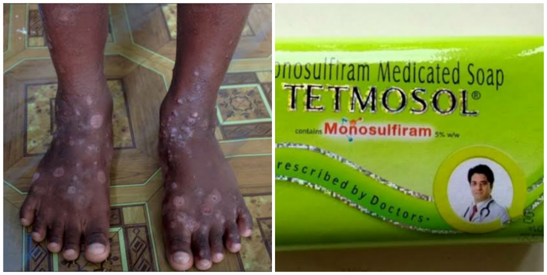 How to use tetmosol soap for scabies How to use tetmosol soap for scabies