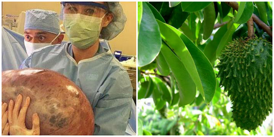 Can soursop leaves shrink ovarian cyst? Can soursop leaves shrink ovarian cyst?