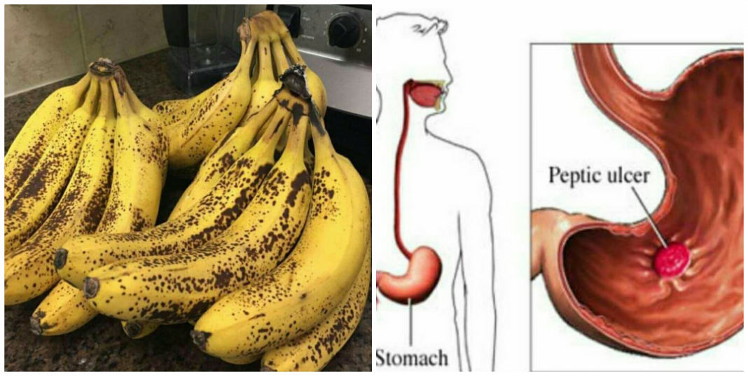 Is ripe banana good for ulcer patient? Is banana good for ulcer