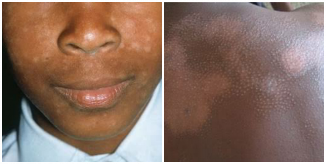 Drugs for eczema treatment in Nigeria What can i use to Cure Eczema in Nigeria?