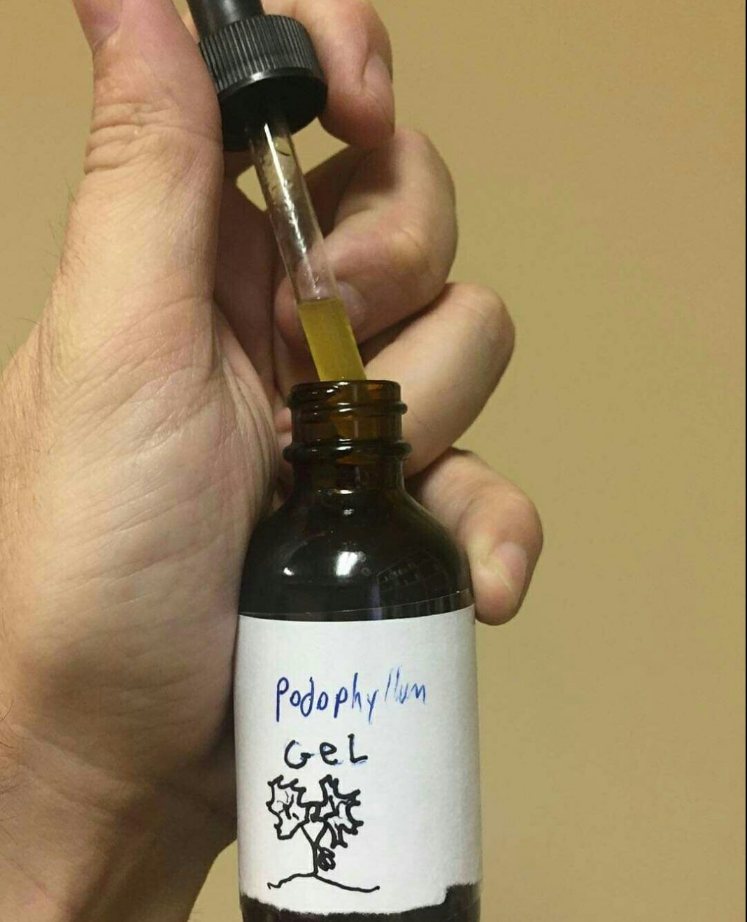 side effects of podophyllin/podowart Podowart/Podophyllin burns - side effects of podophyllin