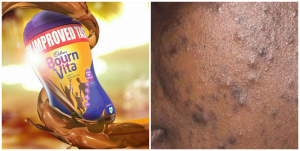 Does bournvita cause pimples, cough and constipation?