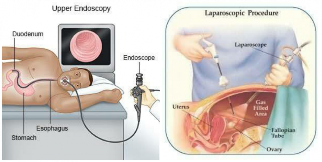 Endoscopy Vs Laparoscopy Difference between endoscopy and laparoscopy