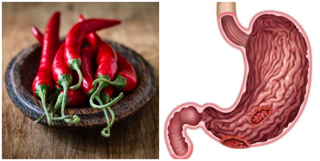 Is capsaicin good for ulcer patients? Is chilli pepper good for ulcer?