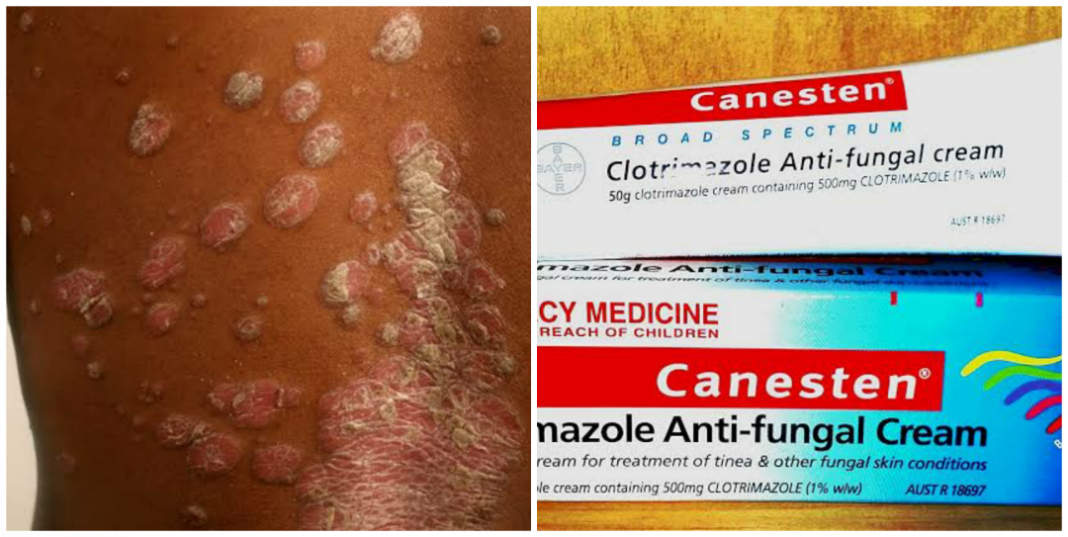 Creams and Drugs for skin infection in Nigeria
