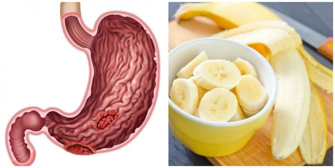 Home remedy for stomach ulcer (peptic ulcer) in Nigeria Home remedy for stomach ulcer in Nigeria