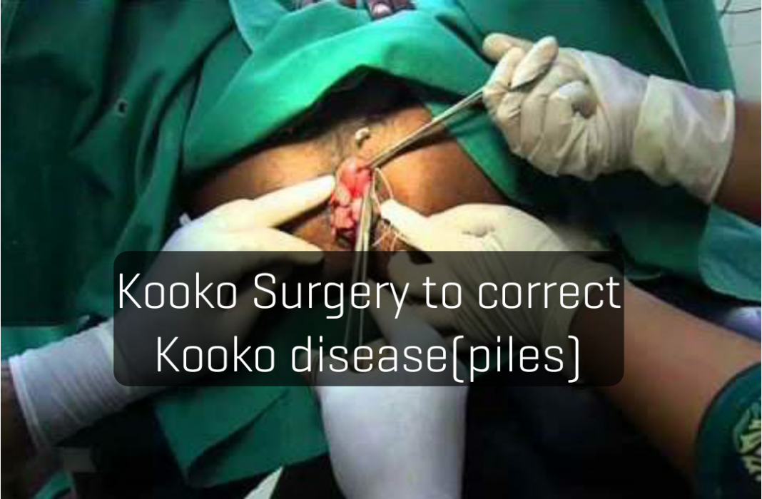 Kooko (Piles or Hemorrhoids): Causes, Symptoms, Effects & Treatment (Kooko Medicine).