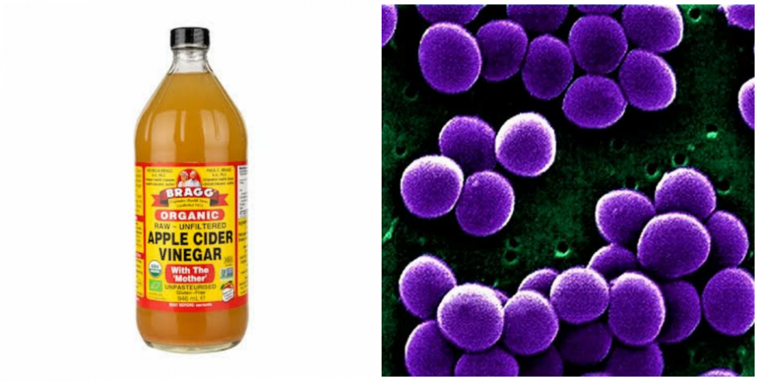 How to use apple cider vinegar for staph infection How to use apple cider vinegar for staph infection