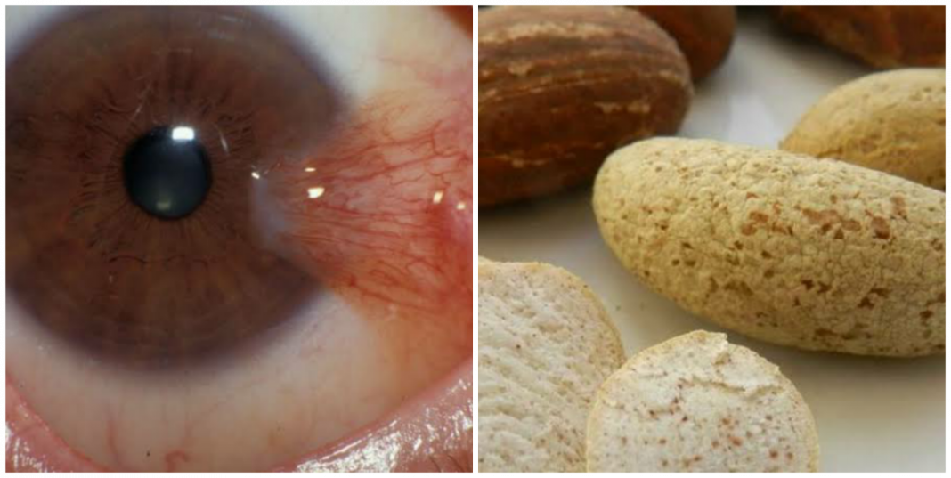 Can bitter kola cure pterygium? (Bitter Kola and Eye Problems) Can bitter kola cure pterygium? (Bitter Kola and Eye Problems)