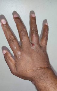 How can I test myself for scabies