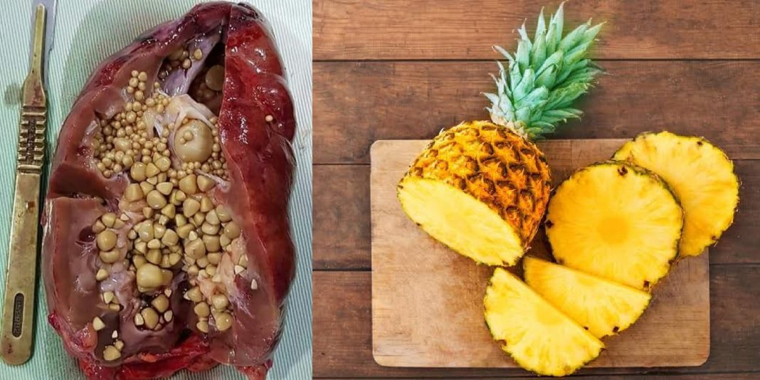Is Pineapple good for kidney stones?